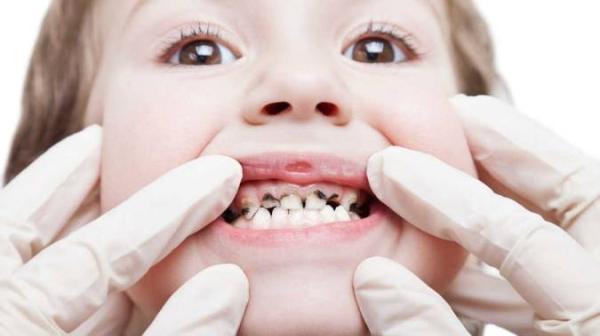 راه های پیشگیری از پوسیدگی دندان در بچه ها